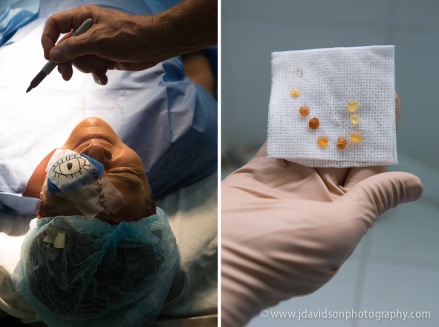 Doctors mark patients patches (left) so that they can easily identify who they operated on the following day during post-ops.  Cataracts removed from patients (right) were a range of opacities and colors.